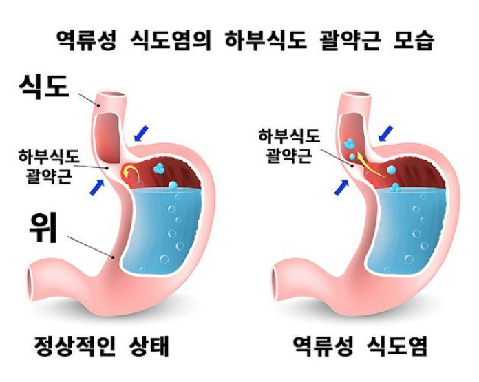 역류성 식도염의 원인/ 증상/ 치료법 바로알기