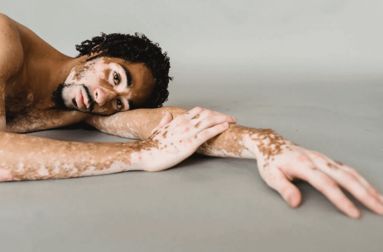 백반증(Vitiligo)의 원인 증상 및 진단/치료방법