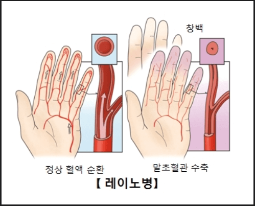 레이노증후군: 손이 차가워지고 점점 안 움직여요! 레이노증후군: 손이 차가워지고 점점 안 움직여요!