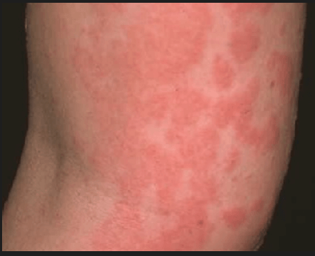 콜린성 두드러기: 원인, 증상 및 치료 이해