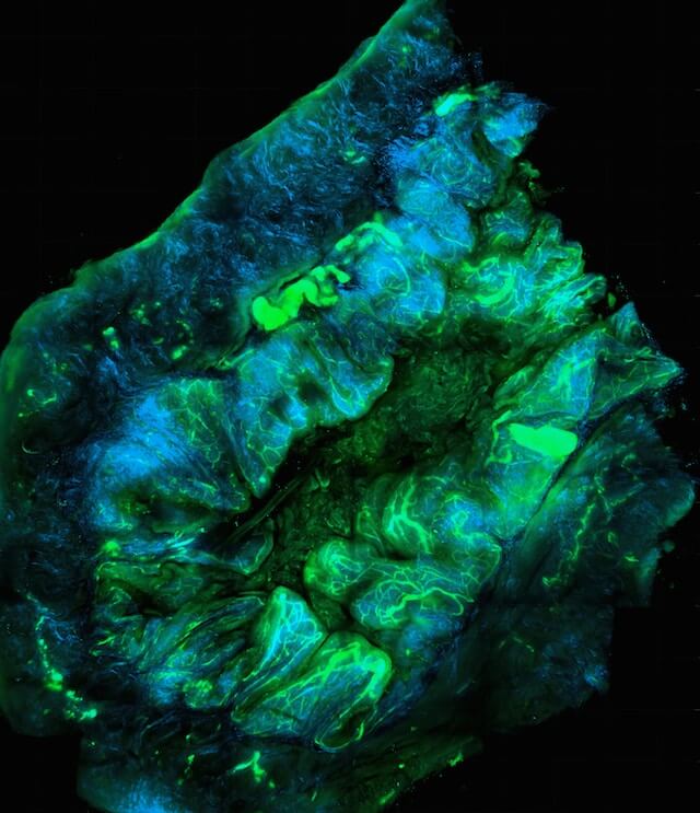 난소 종양에 대한 이해