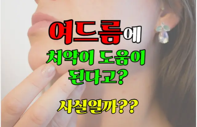 여드름에 치약이 도움이 된다고? 사실일까??