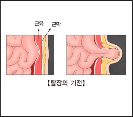 서혜부 탈장 (스포츠 탈장)의 원인과 위험 요소 및 증상/ 수술비용