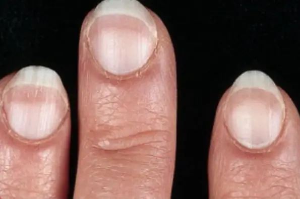 테리의 손톱: 전체가 희고 끝만 분홍빛? 왜 그럴까?