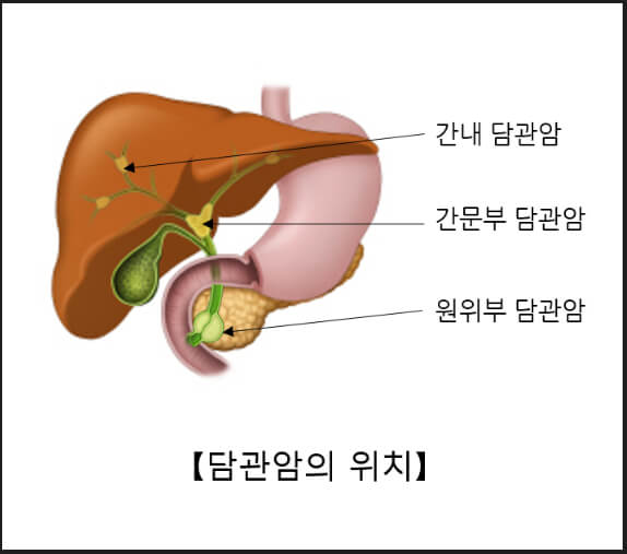 담도암 (담관암), 더 이상 두렵지 않다! 담도암과 면역항암제