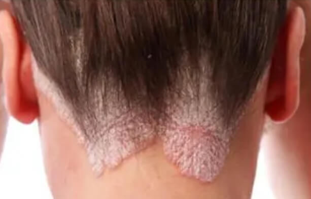 건선과 두피 건선, 겨울에 주의해야 할 이유는?