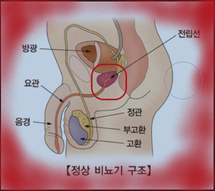 국내 전립선암 증가의 경고: 원인, 증상, 예방법 국내 전립선암 증가의 경고: 원인, 증상, 예방법